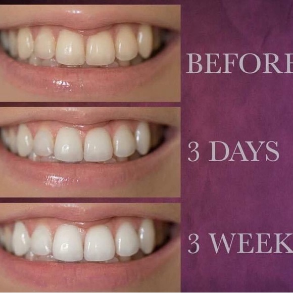 Whitening Toothpaste - Picture 5 of 16